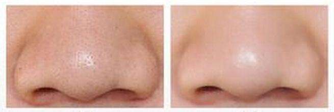 去黑头的方法使用效果展示