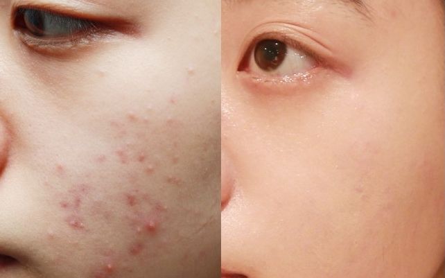 脸上长痘的原因有哪些