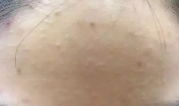 去除粉刺的注意事项有哪些？