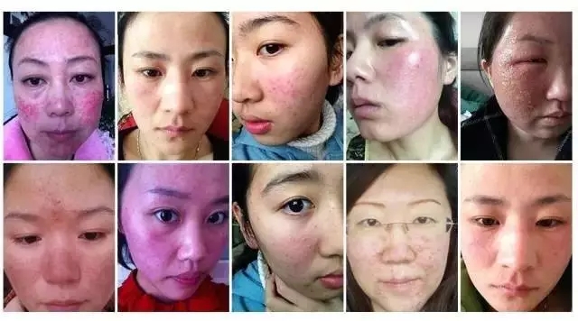 如何判断自己的皮肤是不是激素脸？