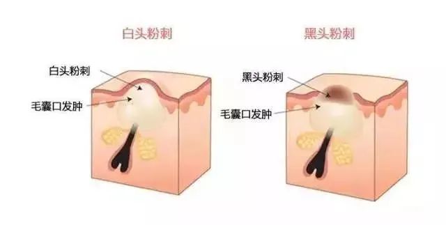 如何有效改善闭口粉刺？改善闭口粉刺的方法！