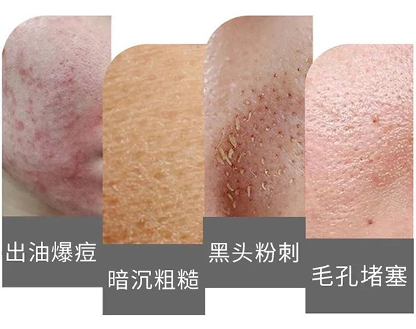 如何预防毛孔堵塞？预防毛孔堵塞的方法