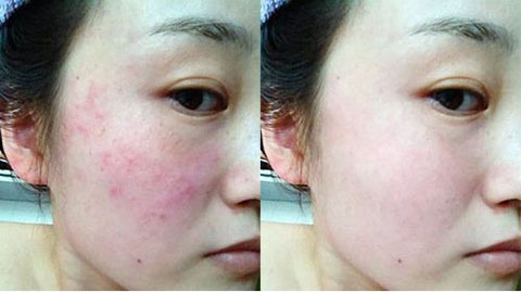 过敏肌肤怎么修复最快？