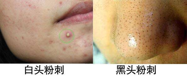 什么是痤疮，什么是粉刺？痤疮和粉刺有啥区别？