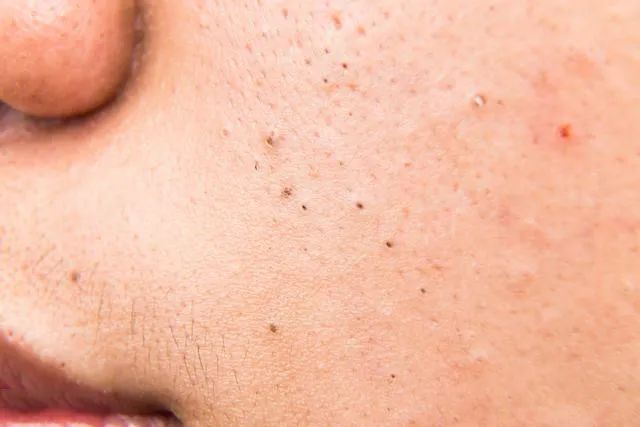 黑头是怎么形成的？如何预防黑头的产生？