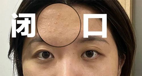 闭口粉刺形成的原因有哪些？