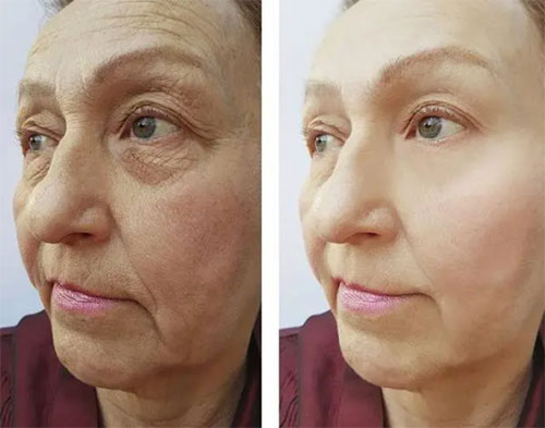 脸部松弛下垂如何改善？面部松弛下垂改善方法！