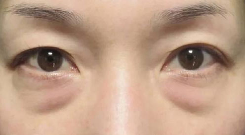 眼袋怎么治疗才能彻底消除？