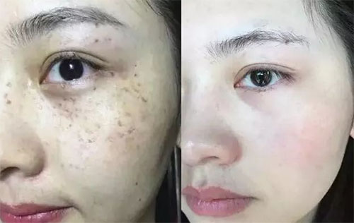 祛斑方法哪种效果最好？
