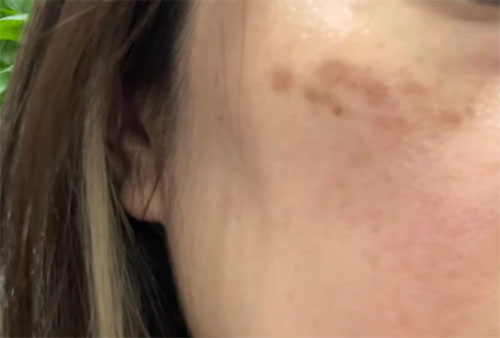 祛斑反黑色素沉着怎么消除？